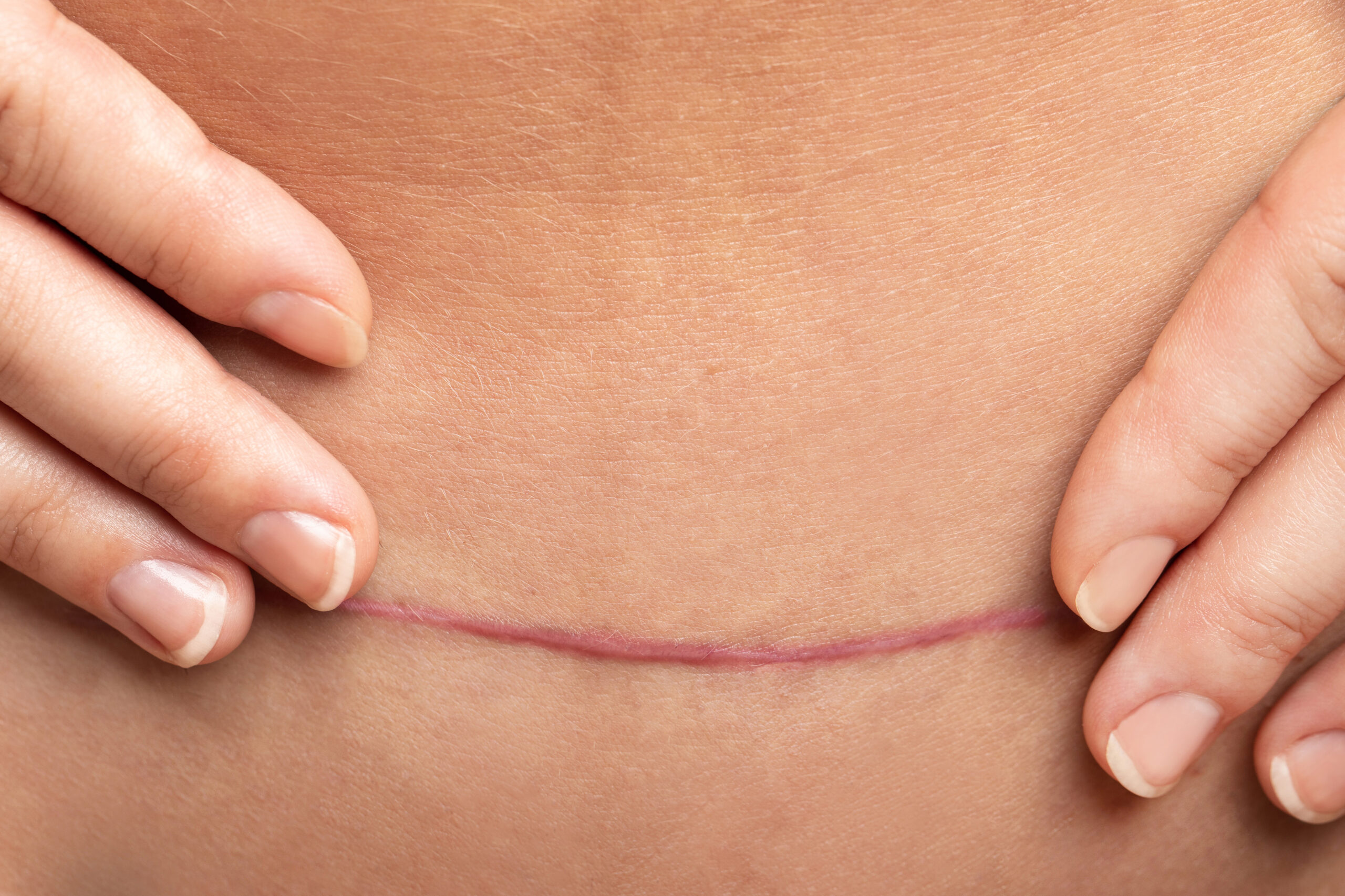 Scar after C-Section surgery on female belly